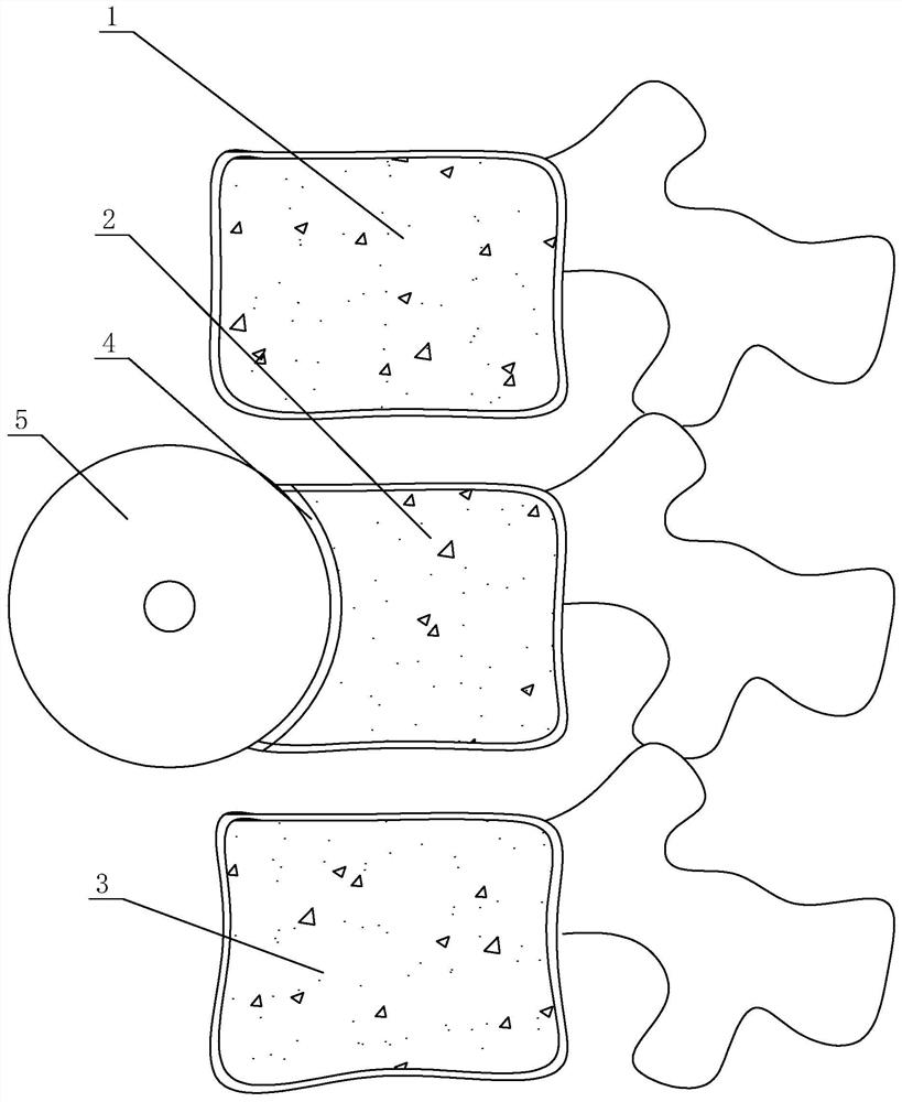 Hidden vertebra support replacement body