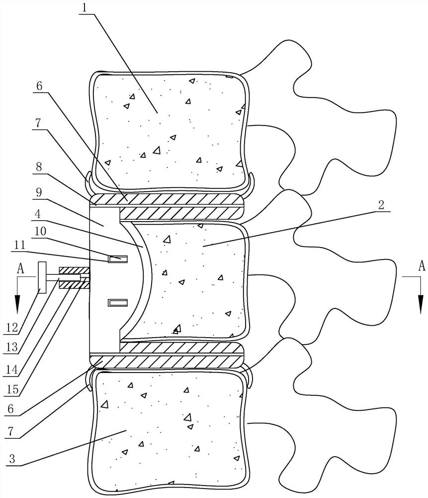 Hidden vertebra support replacement body