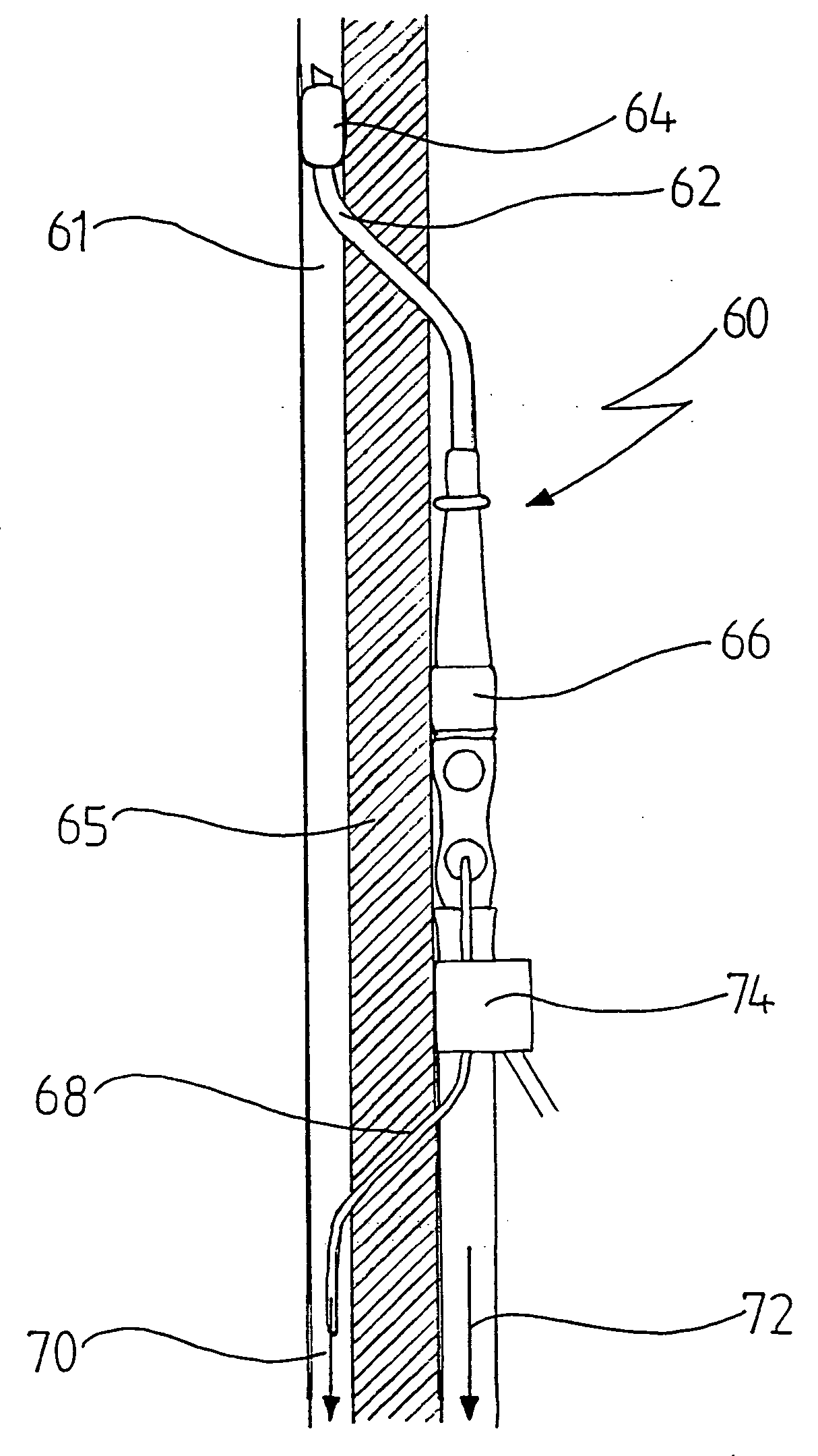 Appliance for cannulation of a blood vessel