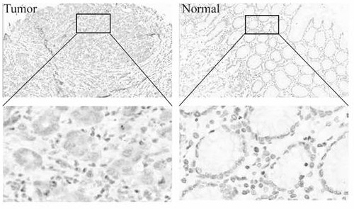 Gastric cancer thermo-chemotherapy sensitive marker and application thereof