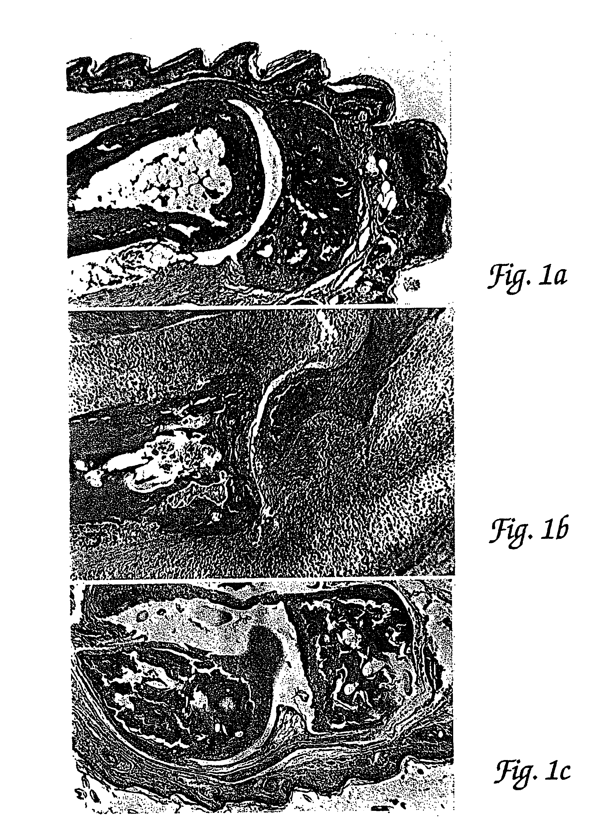 Methods for the treatment of inflammatory joint disease