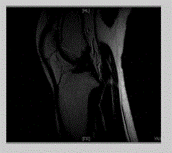 Method for virtually building anterior cruciate ligament on femur and tibia tunnels