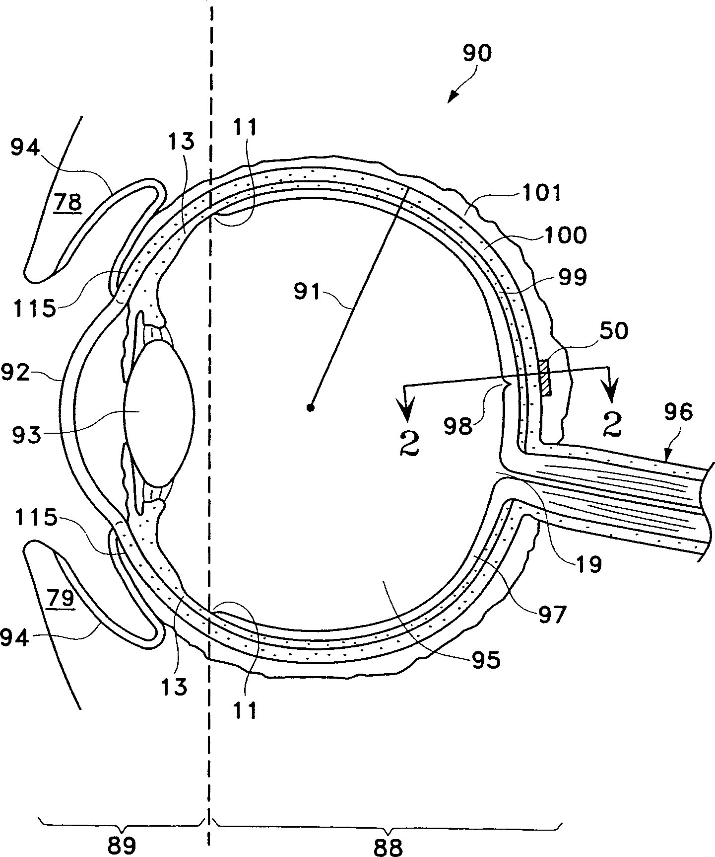 Ophthalmic drug delivery device