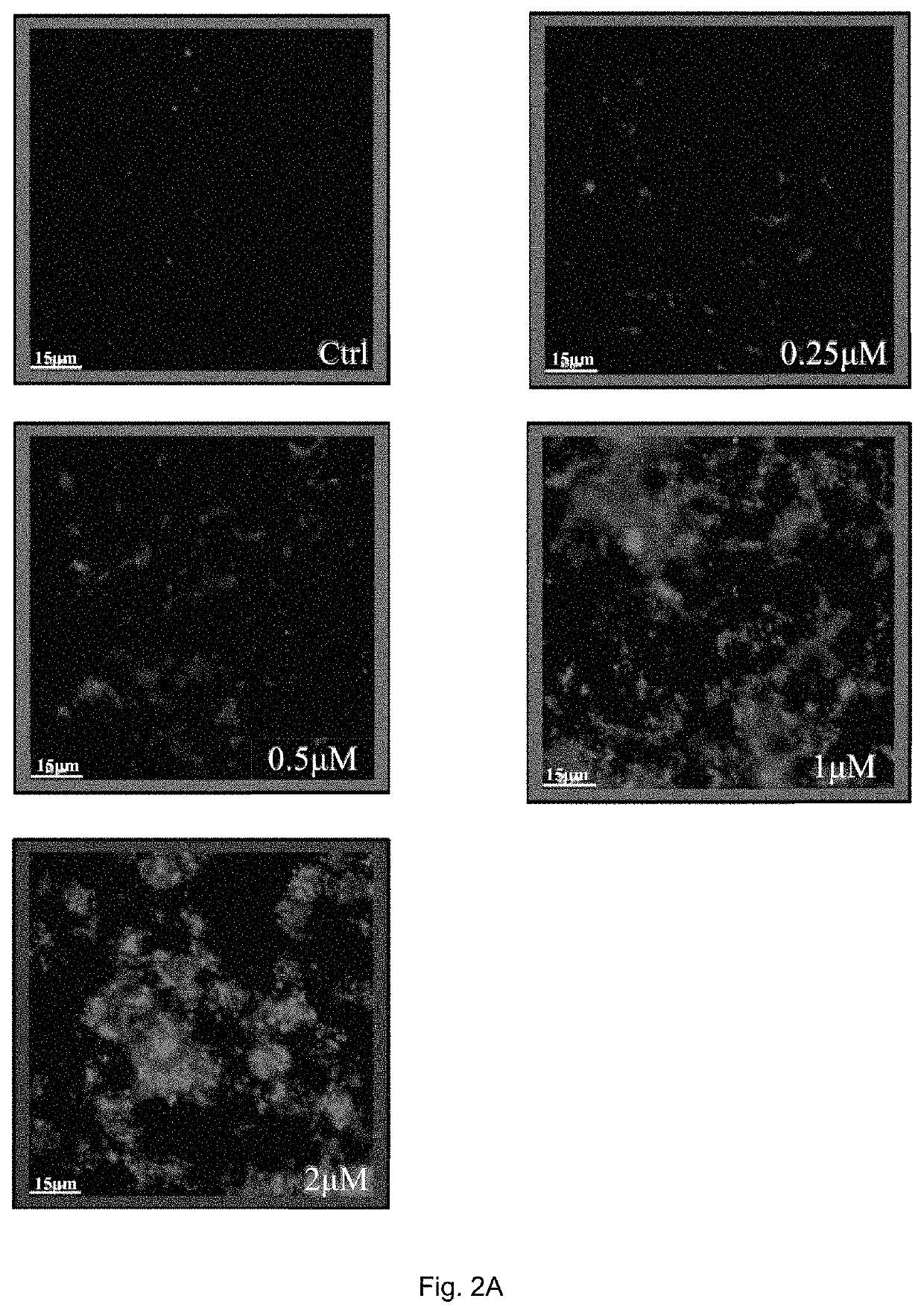 Method of treating refractory rheumatoid arthritis associated with p53 mutation