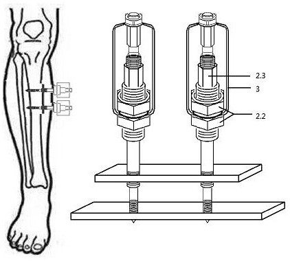 Sleeve external fixation needle for bone transverse moving operation