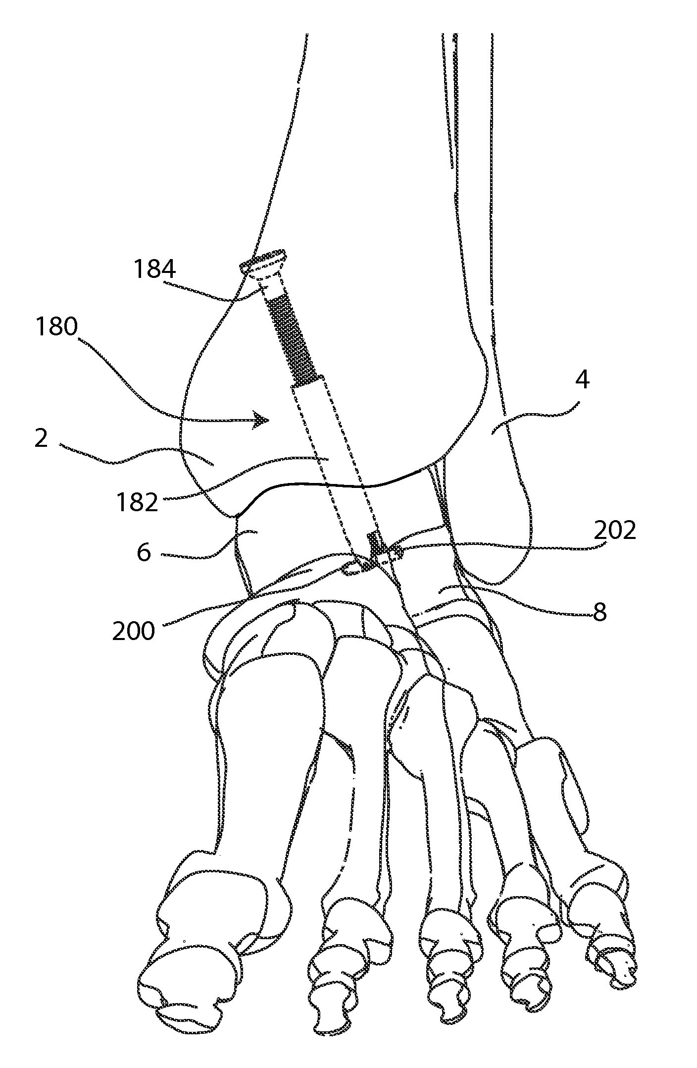 Joint Arthrodesis and Arthroplasty