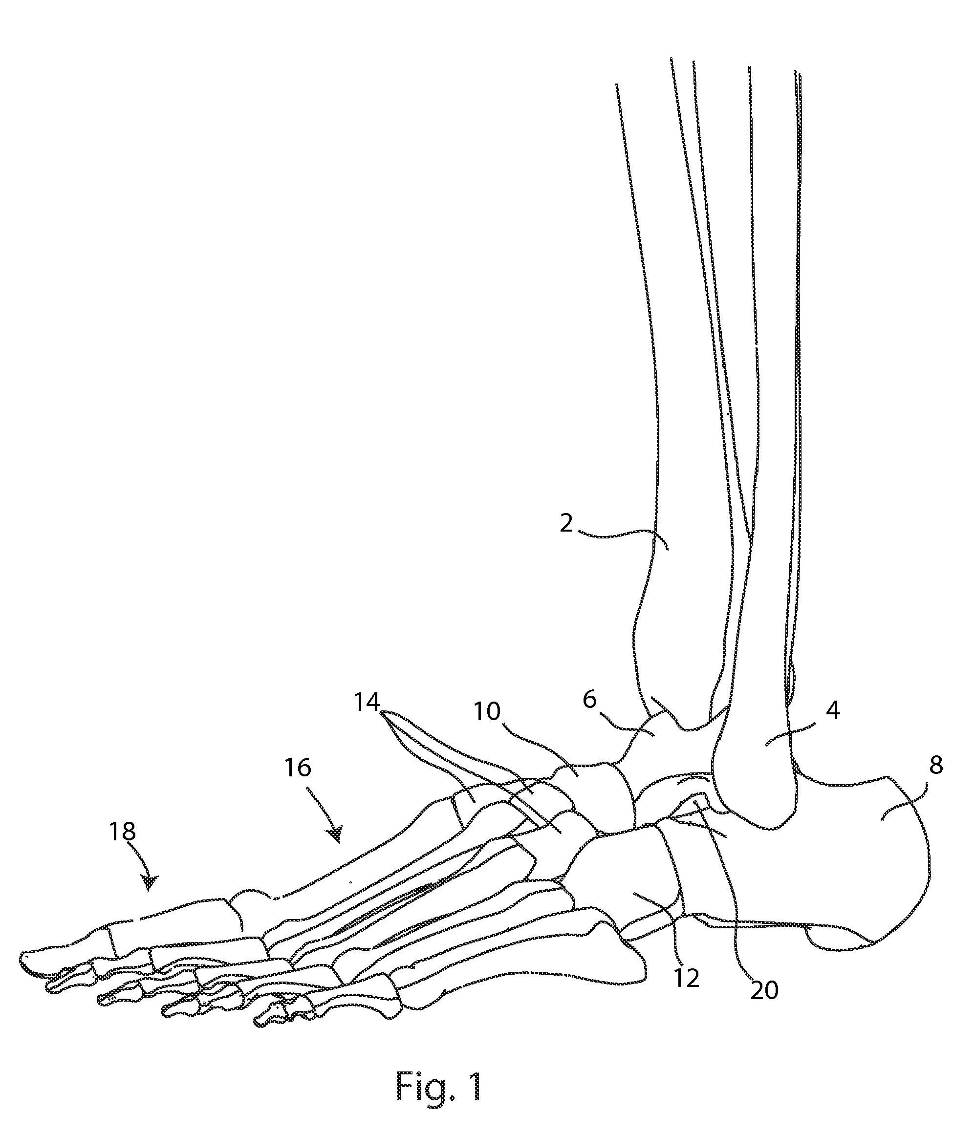 Joint Arthrodesis and Arthroplasty