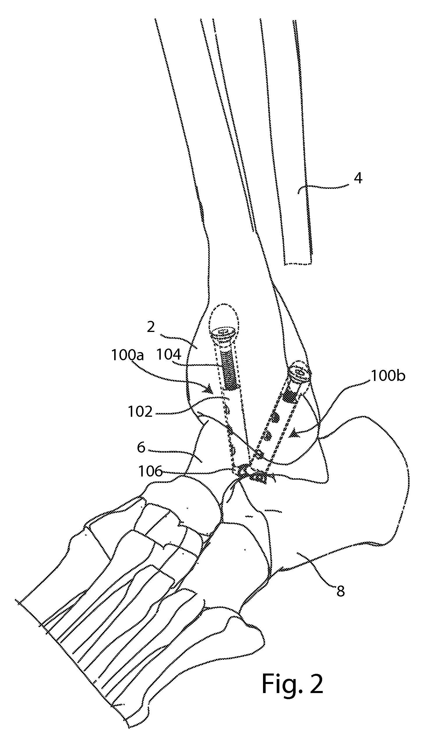 Joint Arthrodesis and Arthroplasty