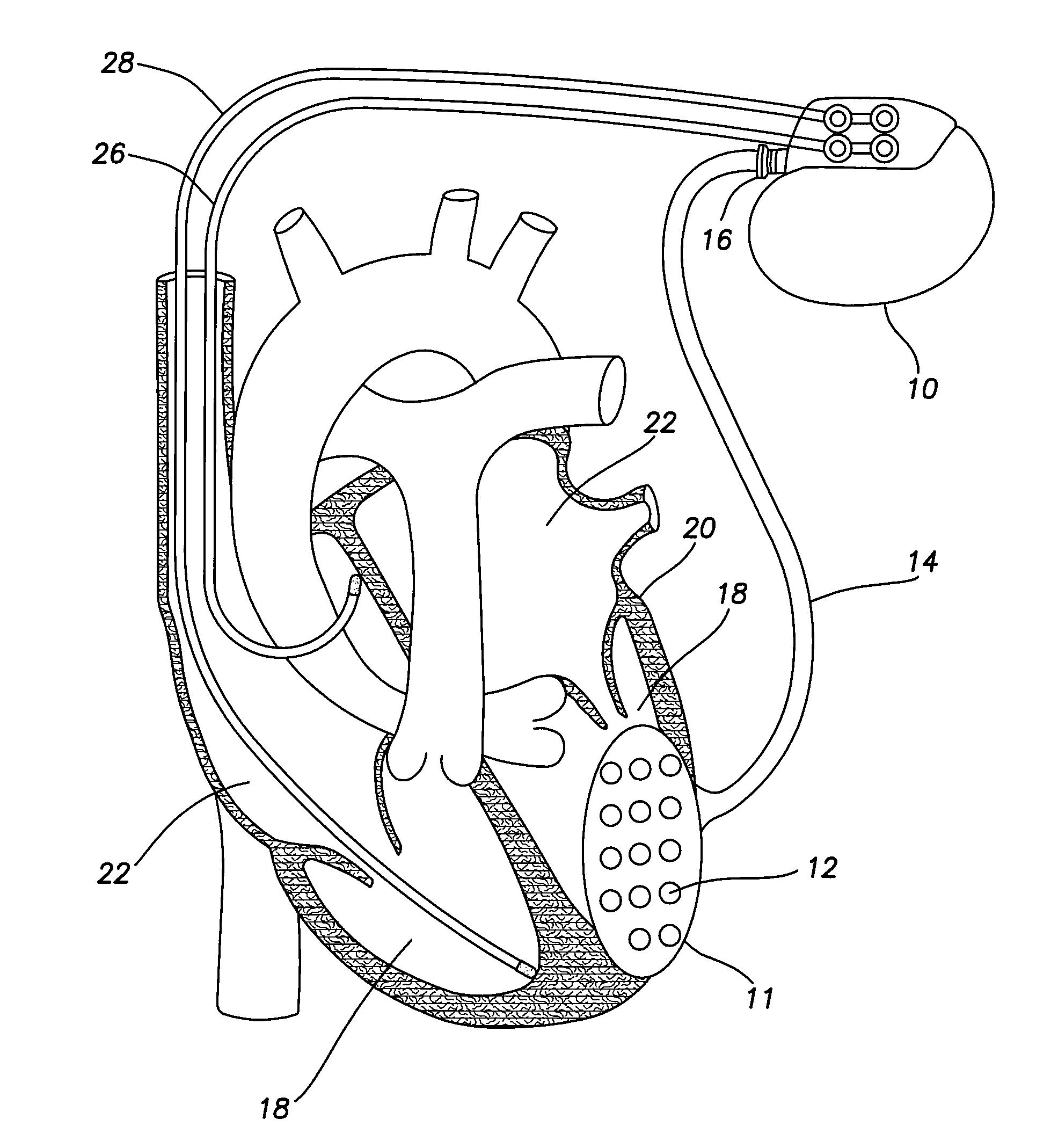 Implantable cardiac patch for measuring physiologic information