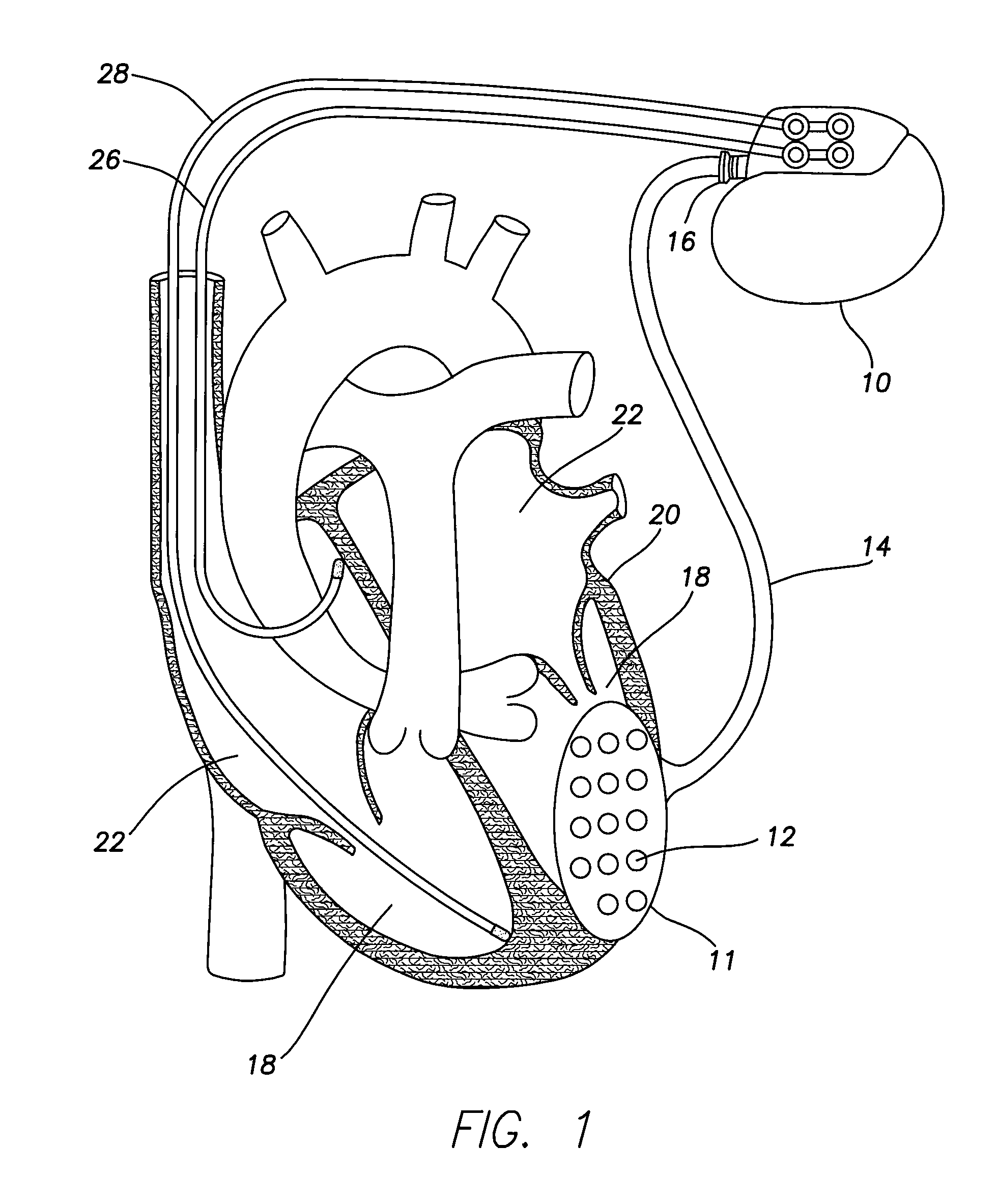 Implantable cardiac patch for measuring physiologic information