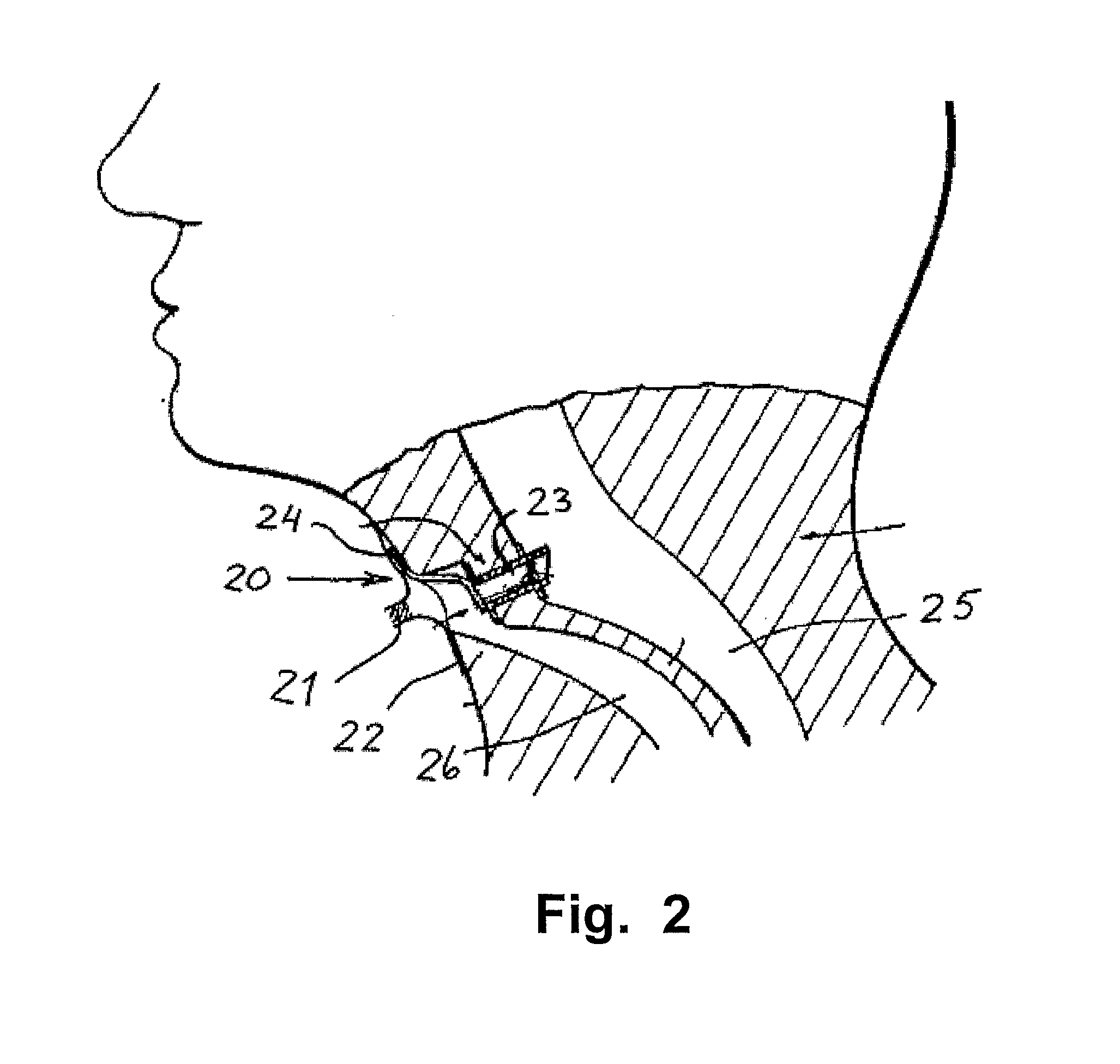 Voice prosthesis, insertion tool and method