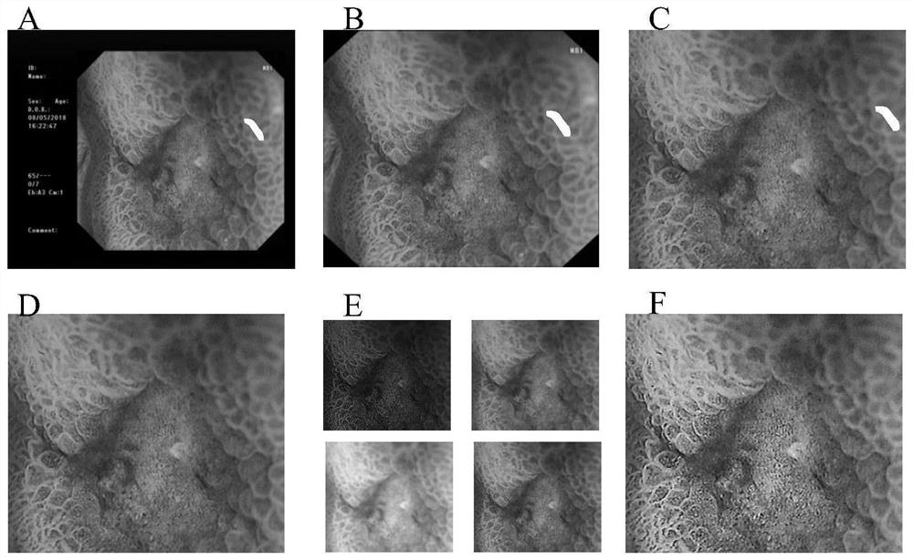 Gastroscope image analysis system and method based on repair and selective enhancement, and equipment