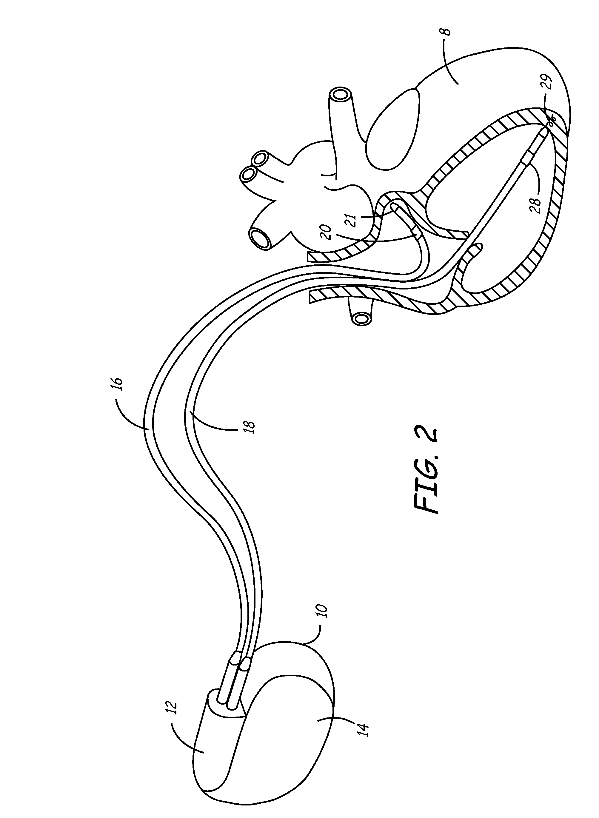 Synchronized atrial anti-tachy pacing system and method