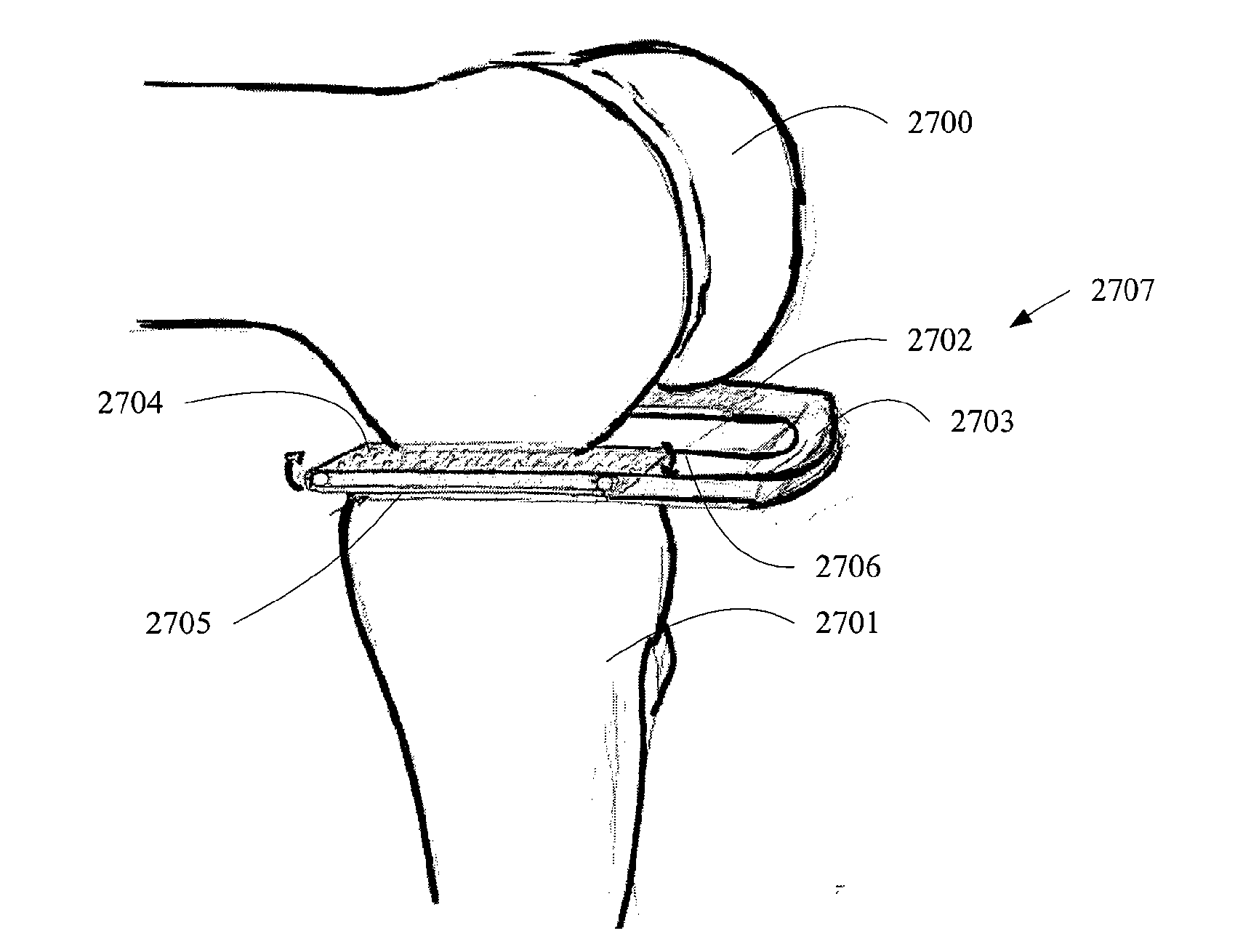 Apparatus and method for sculpting the surface of a joint