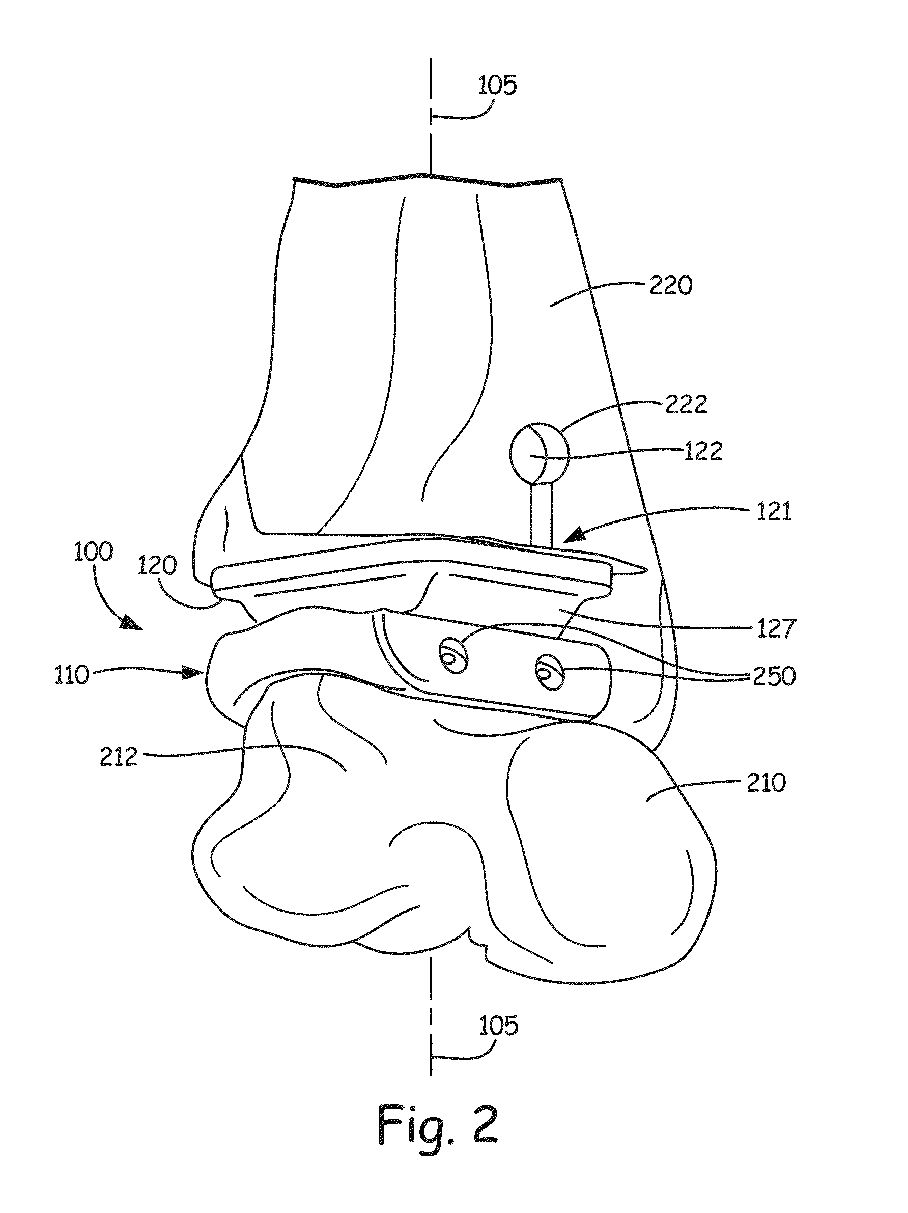 Improved ankle replacement apparatus and method