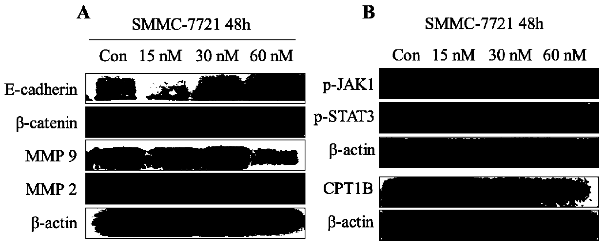 Drug for resisting liver cancer by inhibiting carnitine palmityl transferase 1B (CPT1B)