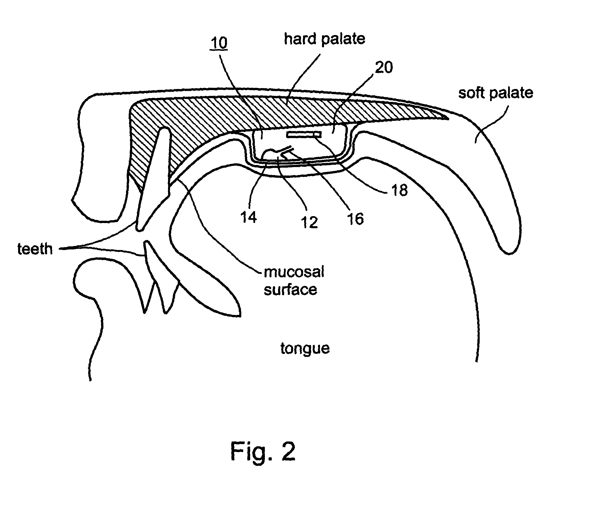 Palatal implant