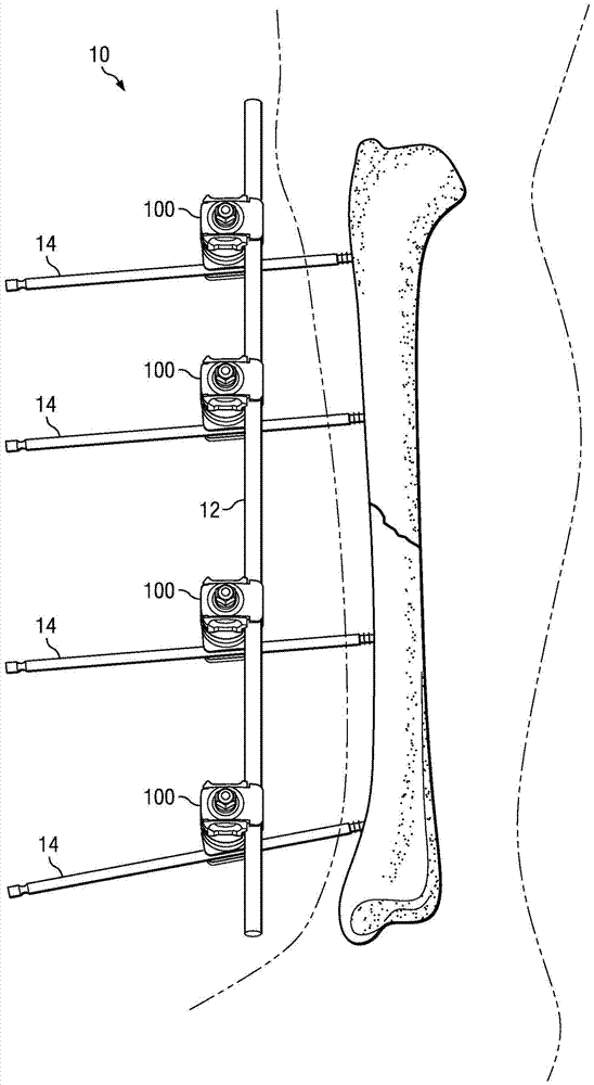 External fixation clamping system using a trigger mechanism and stored spring energy