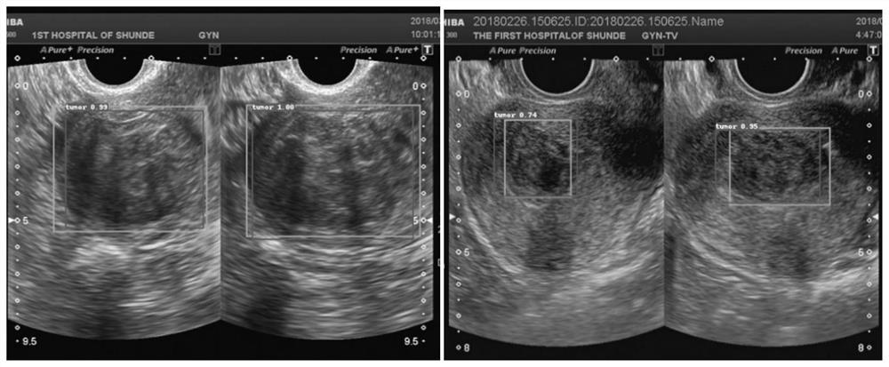 Uterine myoma target image acquisition method based on residual network structure