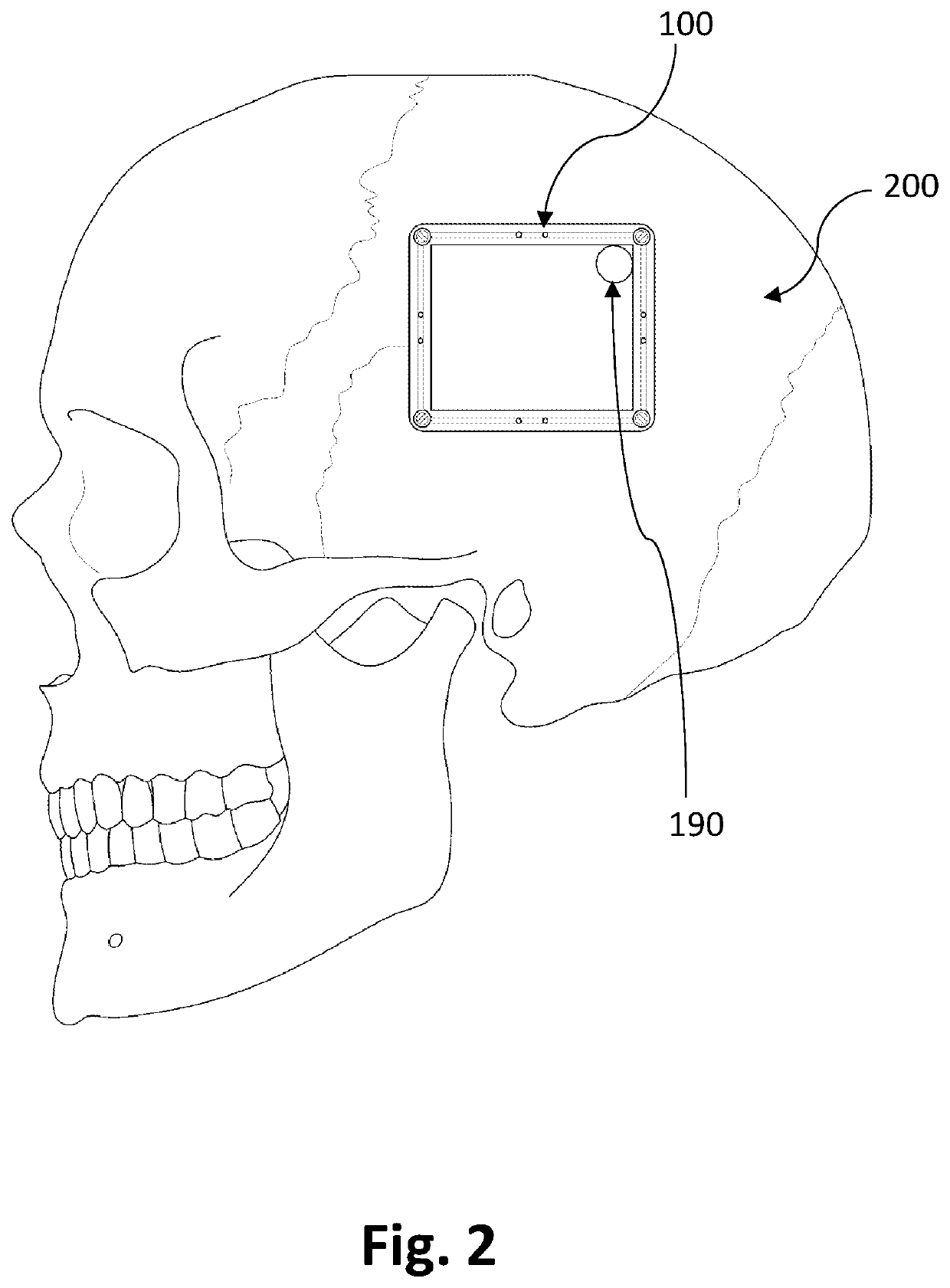 Registration and alignment of implantable sonic windows