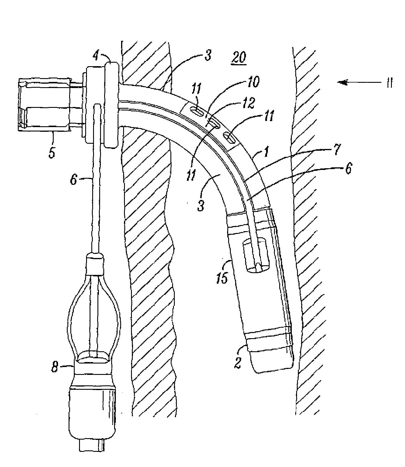 Tracheostomy tubes