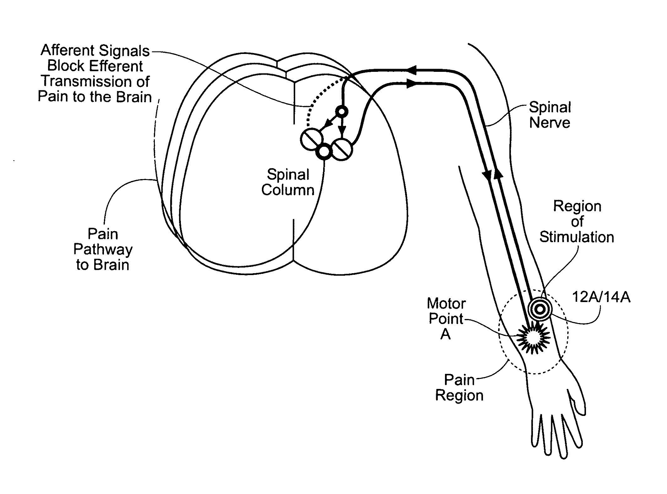 Systems and methods to place one or more leads in tissue to electrically stimulate nerves of passage to treat pain