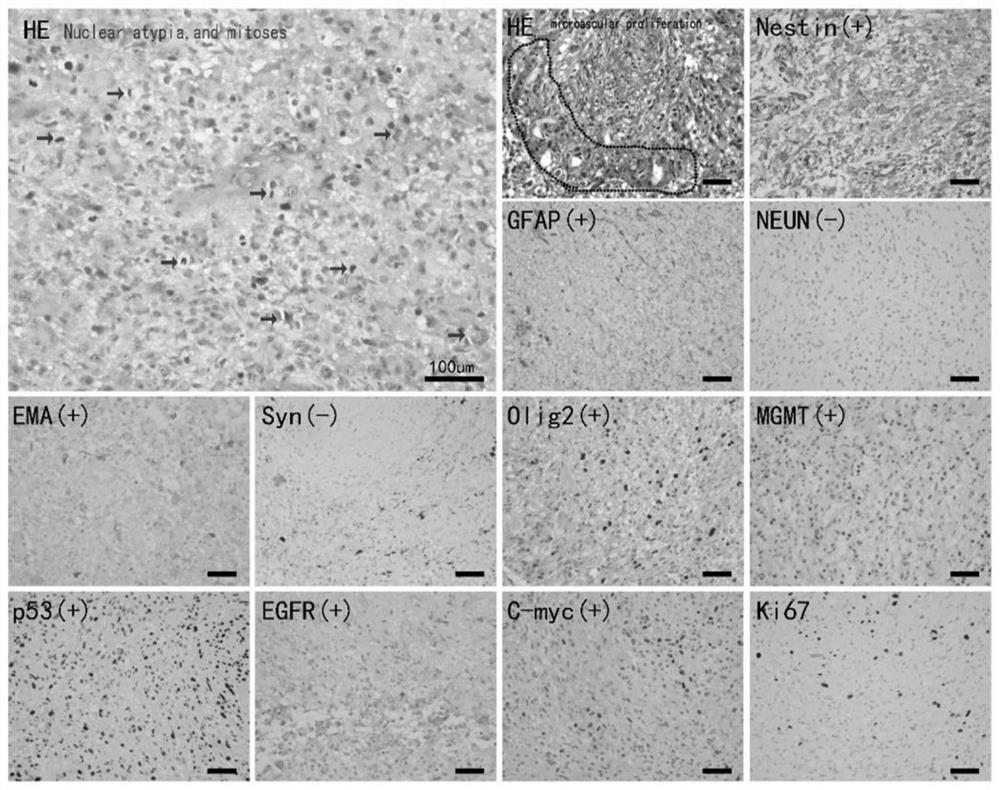 Human glioblastoma cell line GWH04 as well as culture method and application thereof