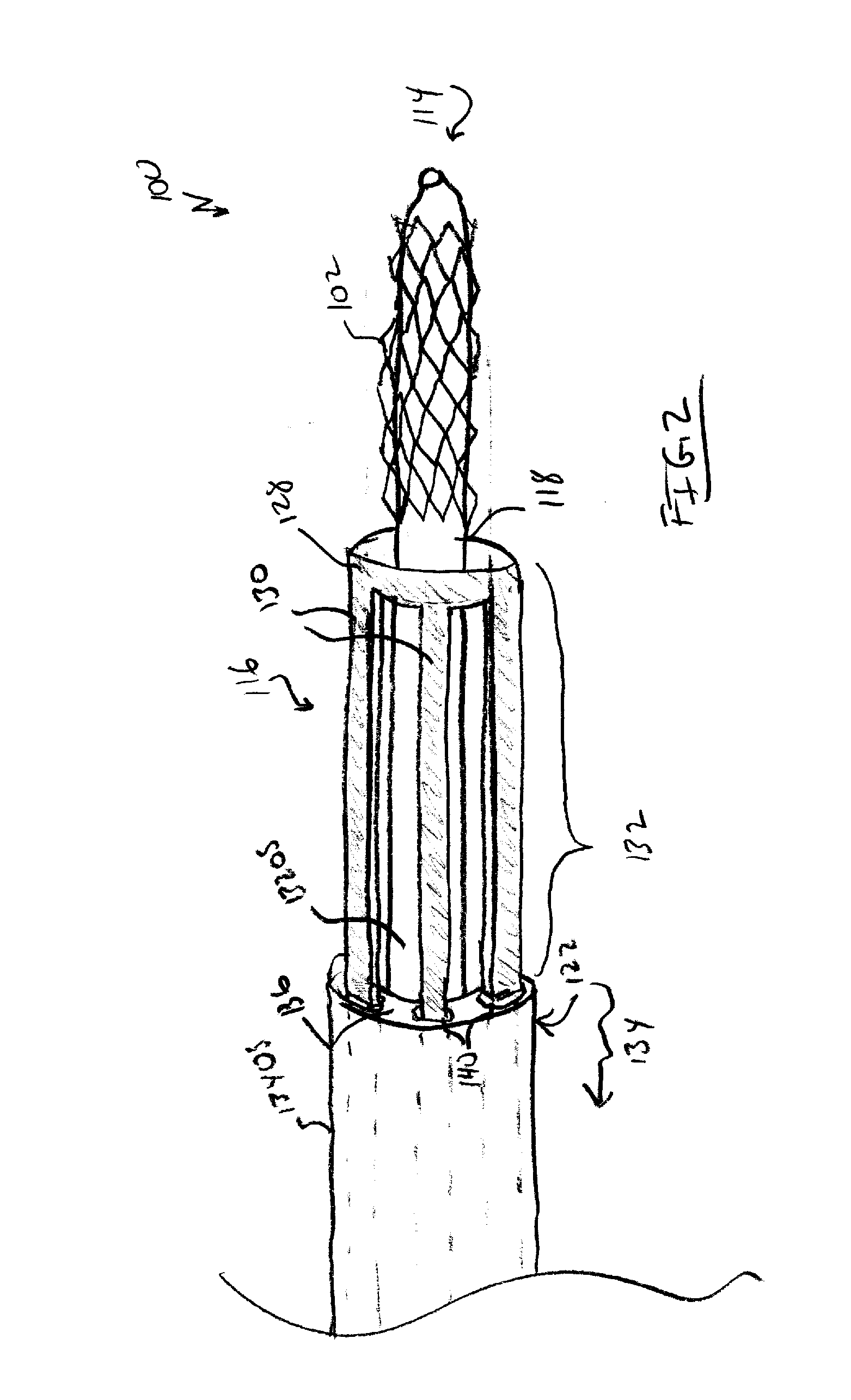 A Mechanism to Ensure Placement of Ostial Renal Stents