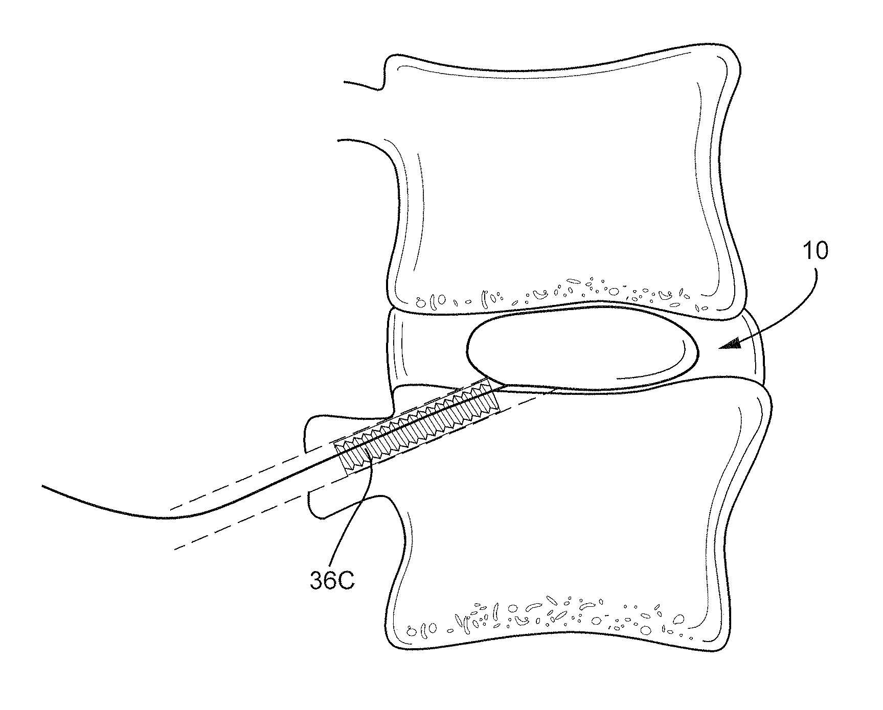 Transpedicular, extrapedicular and transcorporeal partial disc replacement