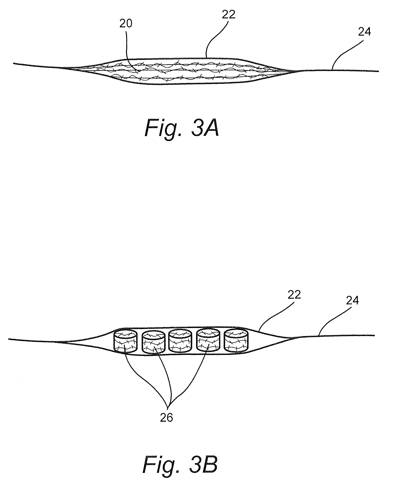 Transpedicular, extrapedicular and transcorporeal partial disc replacement