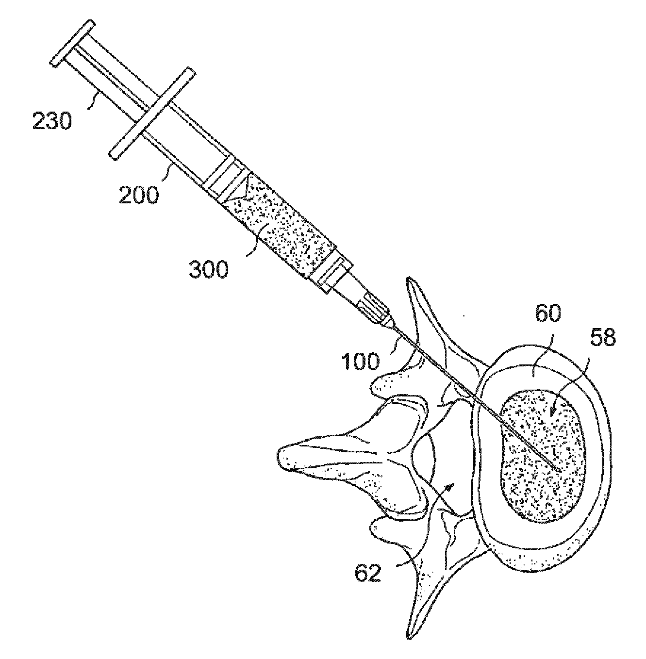 Particle Delivery