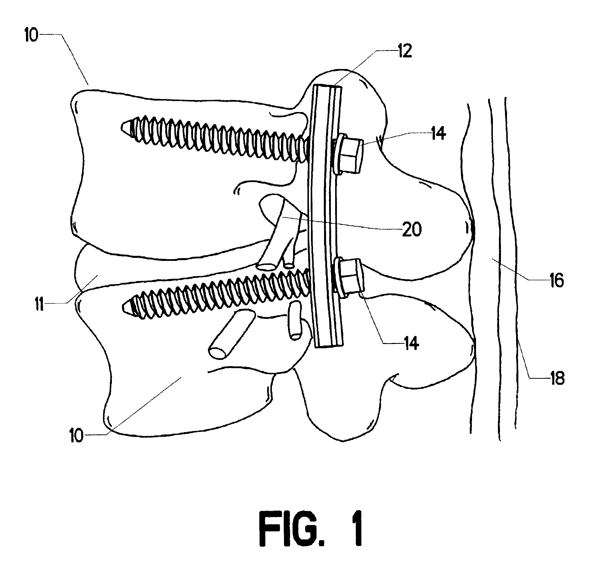 Clamping screw extractor