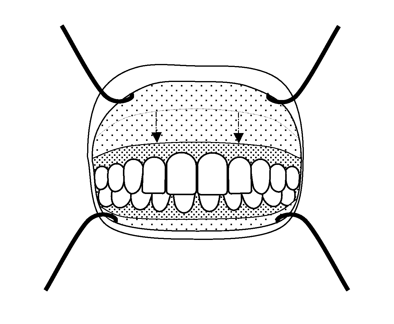 High lip-line smile corrective surgical method