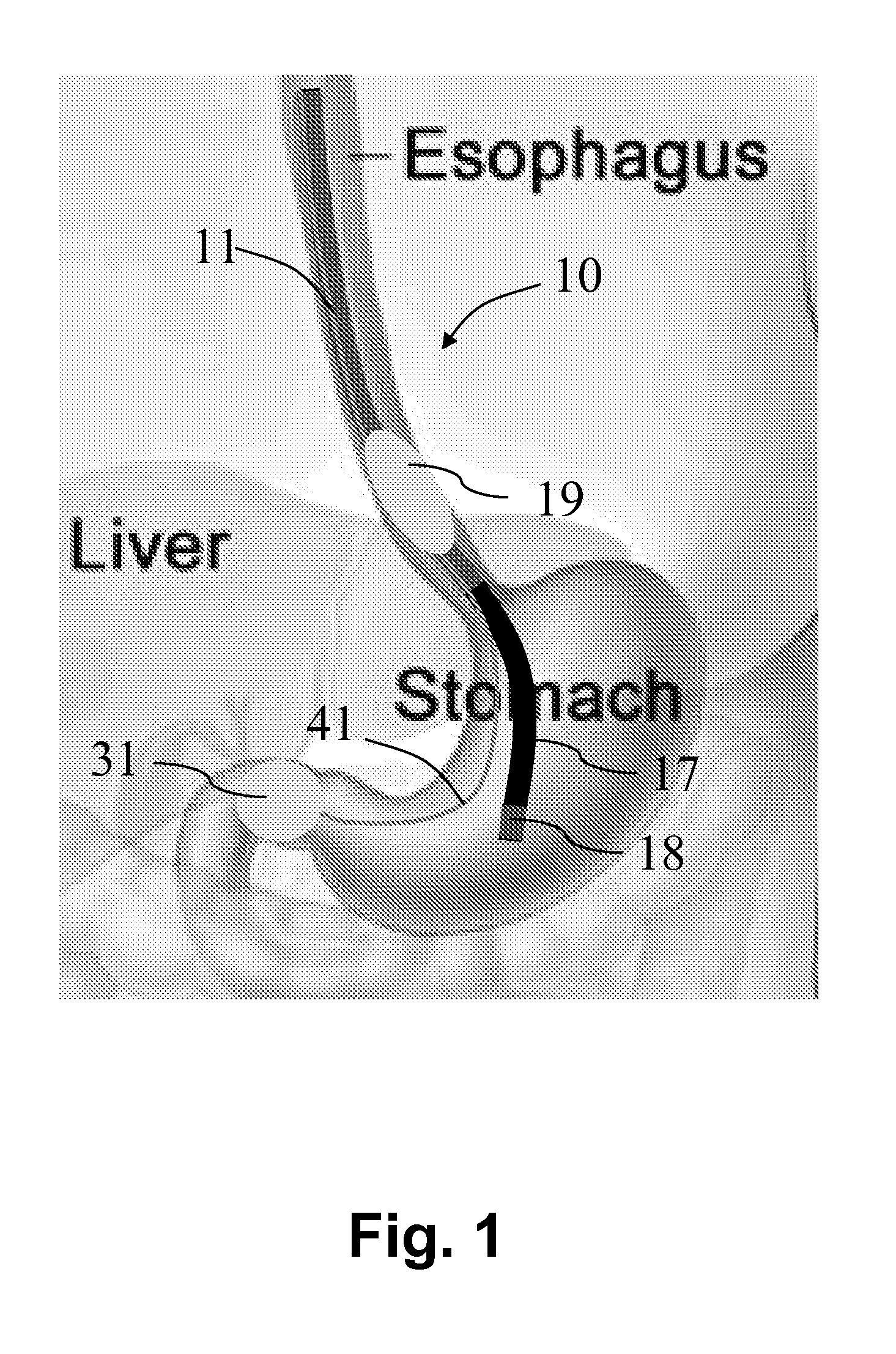 Endoscope Accessory