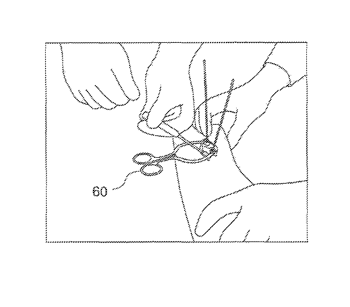 Instruments and methods for complete plantar plate repairs