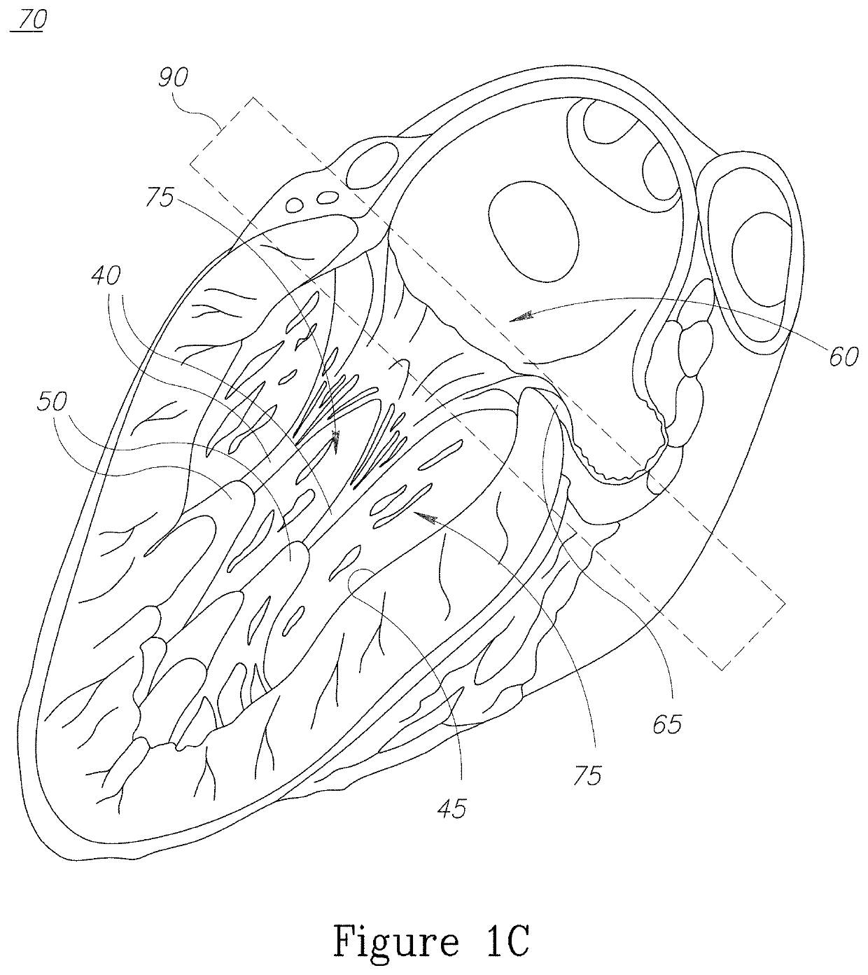 Devices and implantation methods for treating mitral valve condition