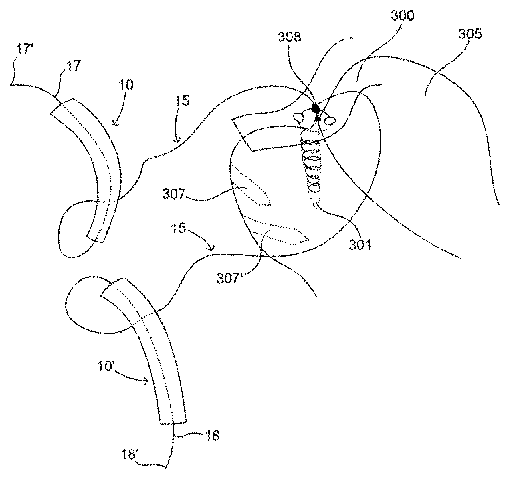 Soft tissue fixation devices and methods