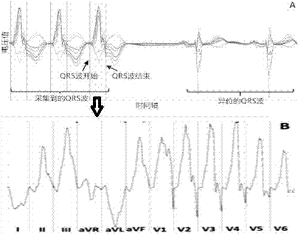 Non-invasive intracardiac hyperexcitability point positioning method based on stack type auto-encoder