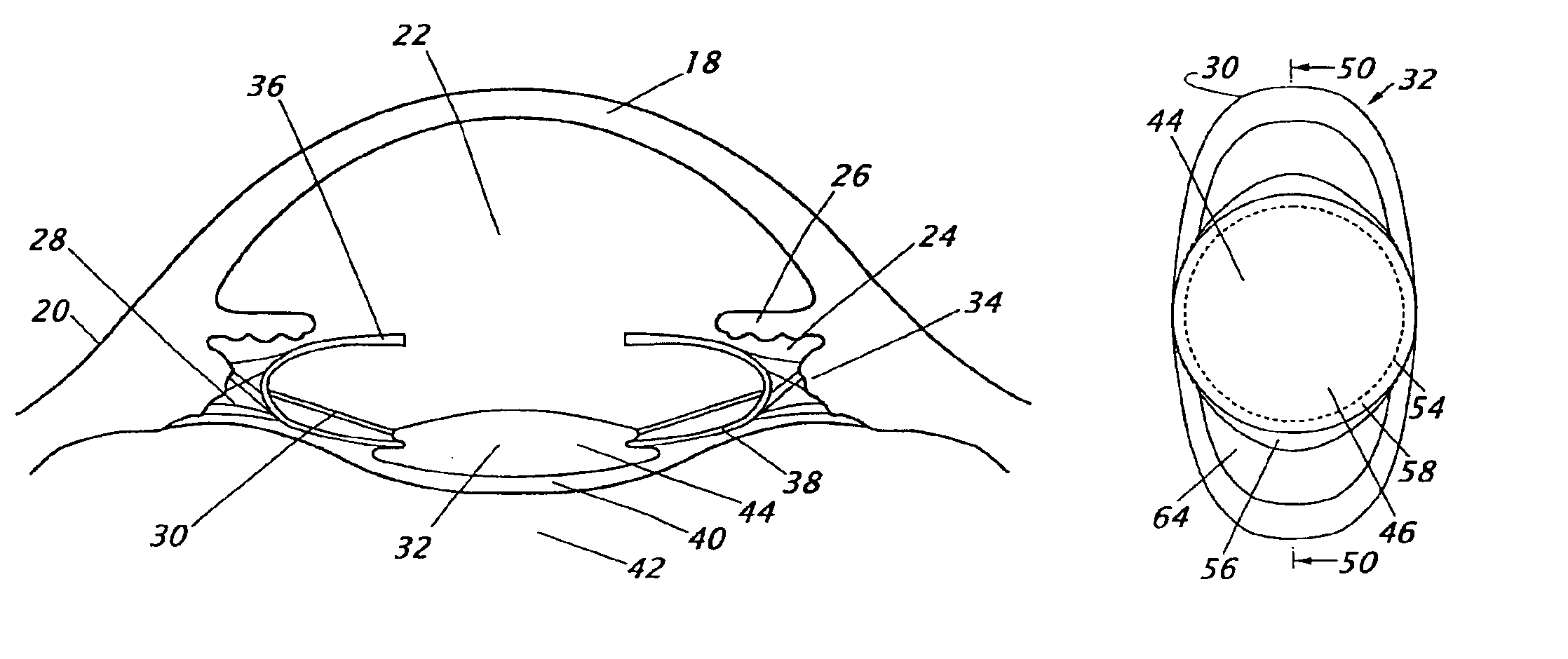 Intraocular lenses with a groove for closing the opening of the posterior capsule