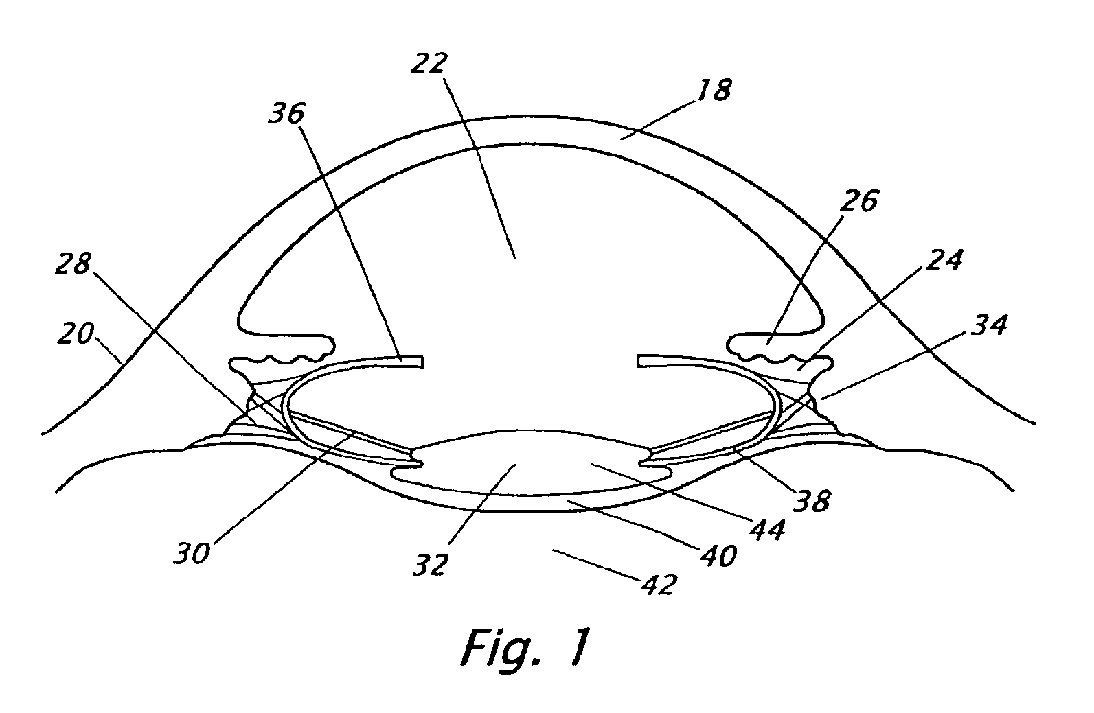 Intraocular lenses with a groove for closing the opening of the posterior capsule