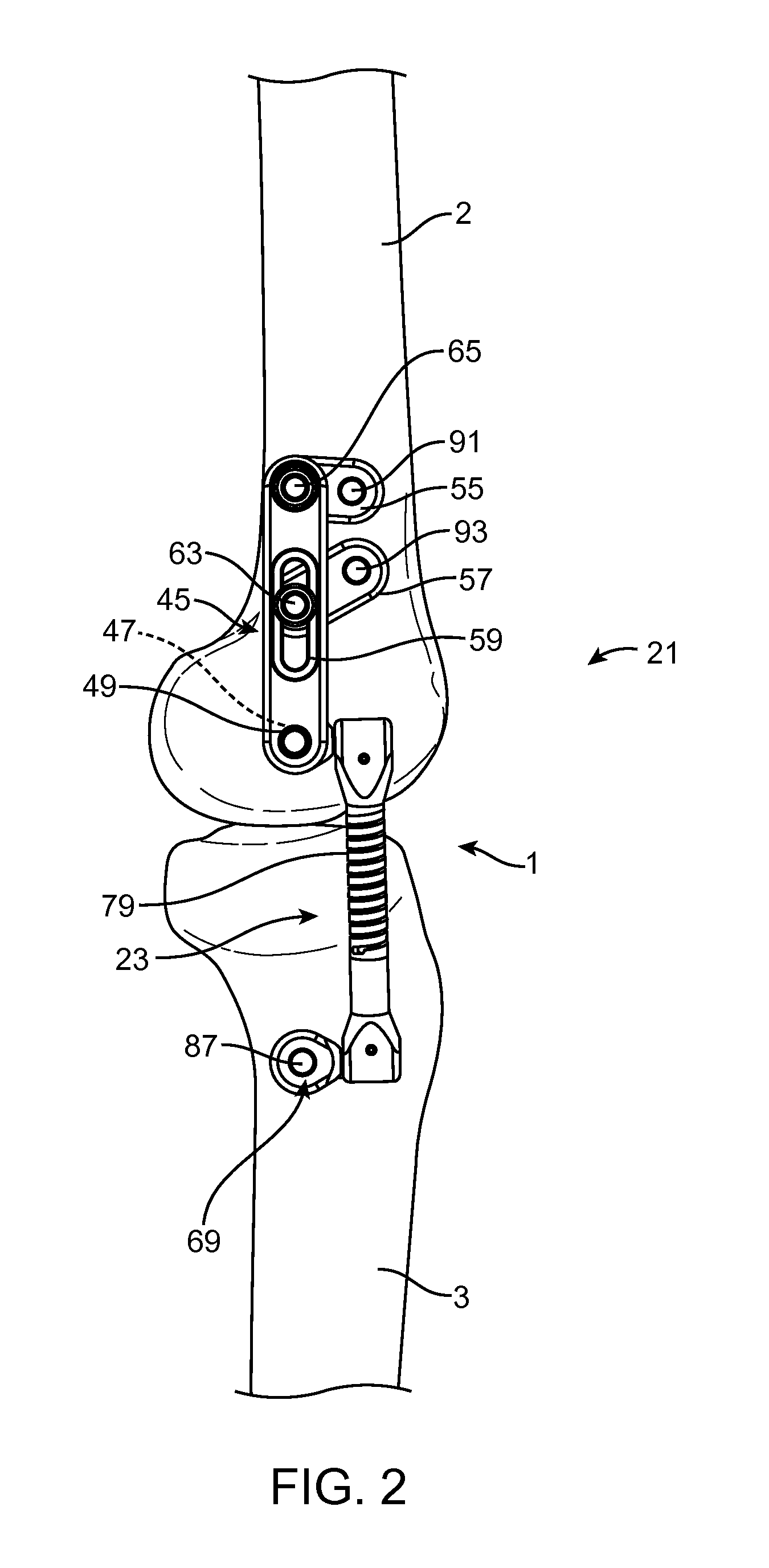 Transcutaneous Joint Unloading Device and Method