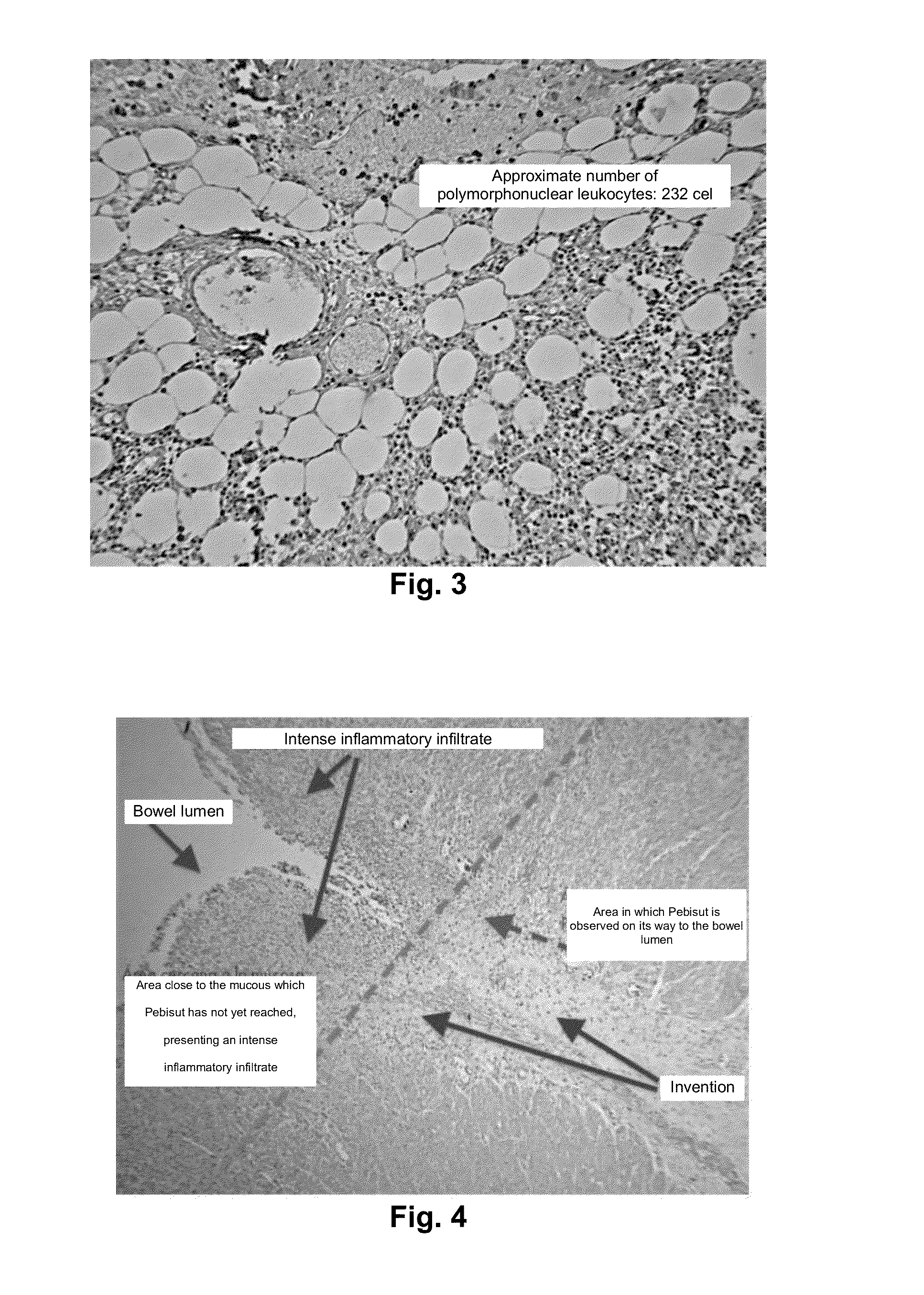 Anti-inflammatory composition for aiding and promoting the healing of chronic ulcerative lesions