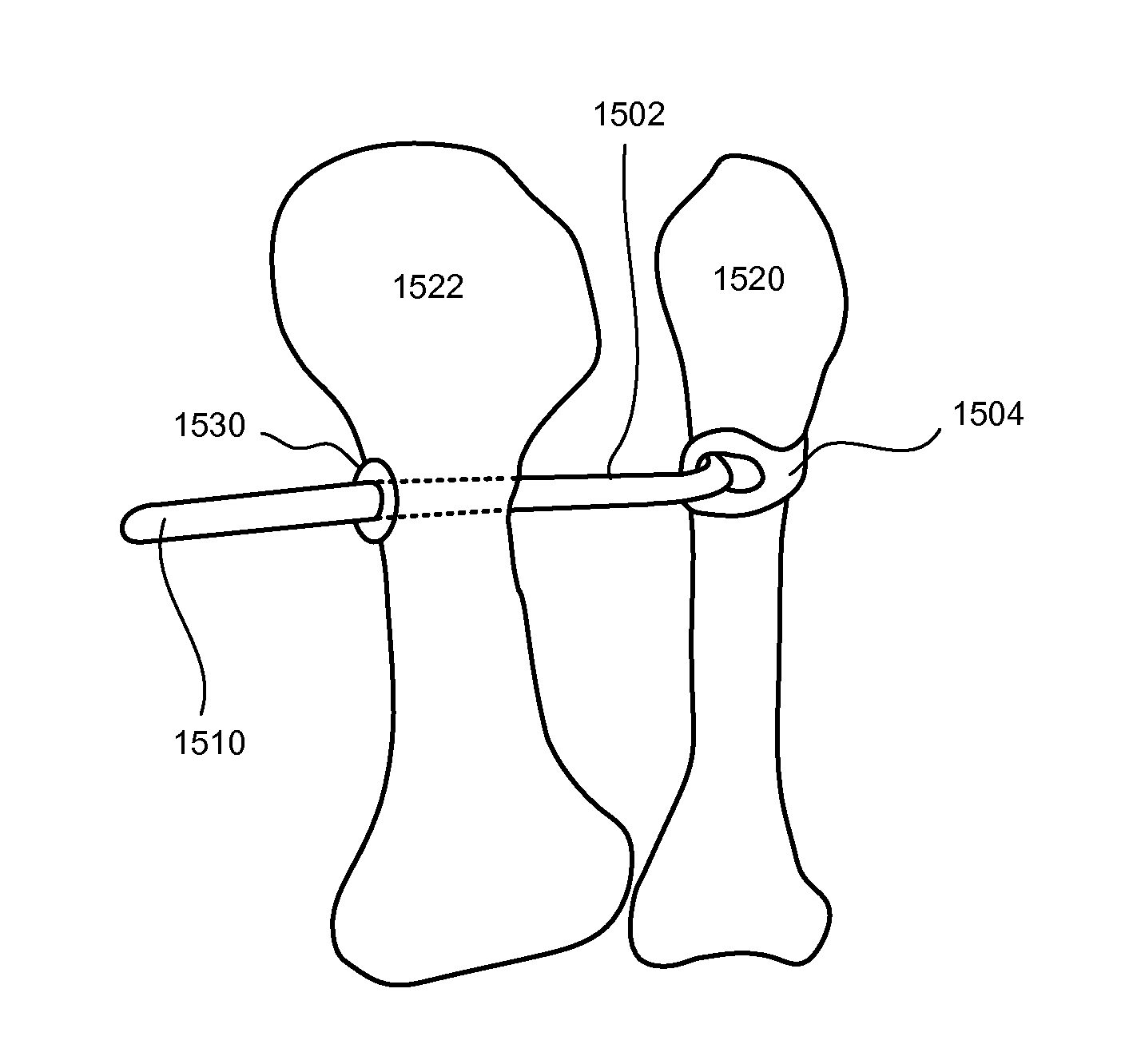 Fixation and alignment device and method used in orthopaedic surgery