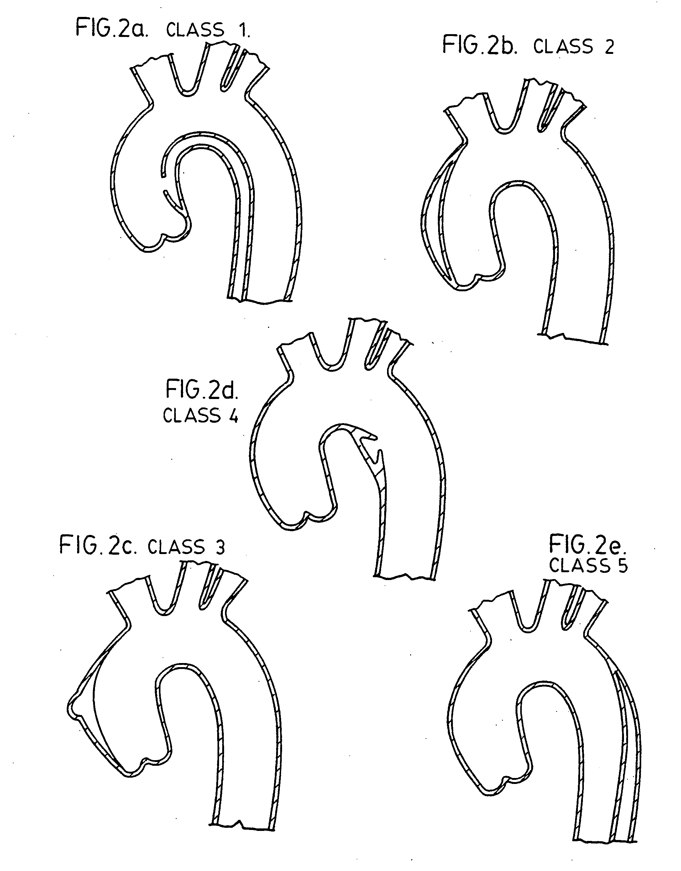 Endovascular prosthesis