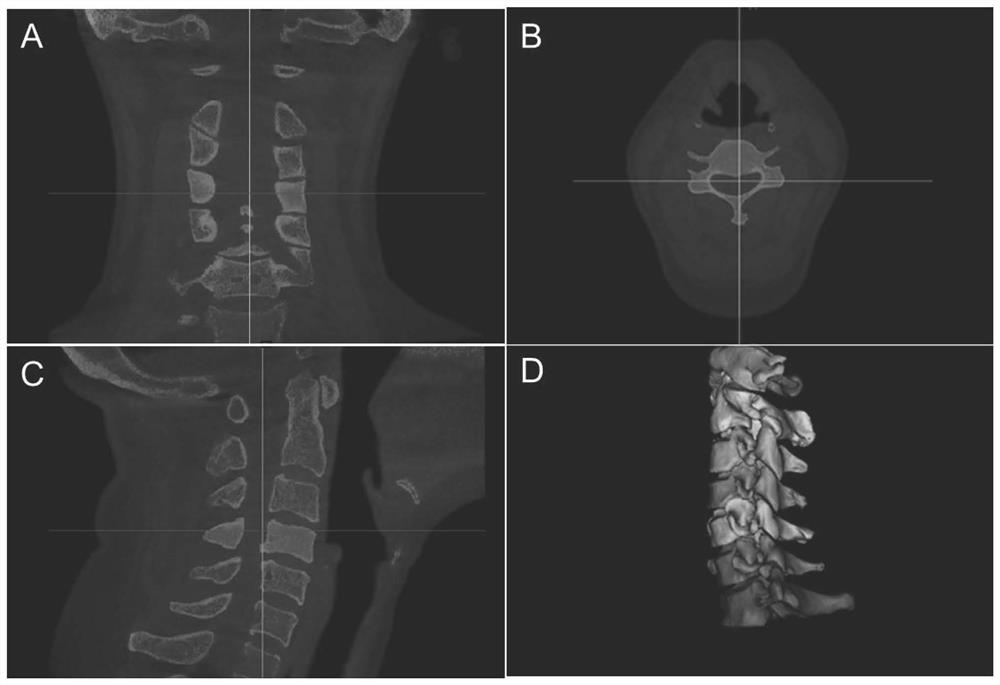 Cone beam CT and image fusion combined cervical vertebra in-vivo three-dimensional motion analysis method