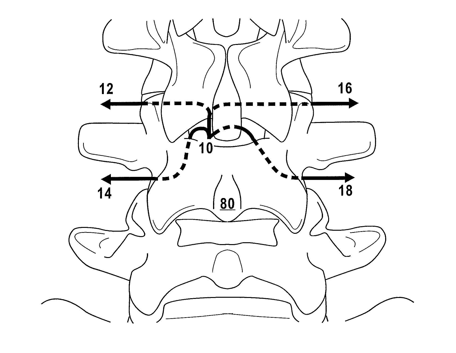 Multiple pathways for spinal nerve root decompression from a single access point