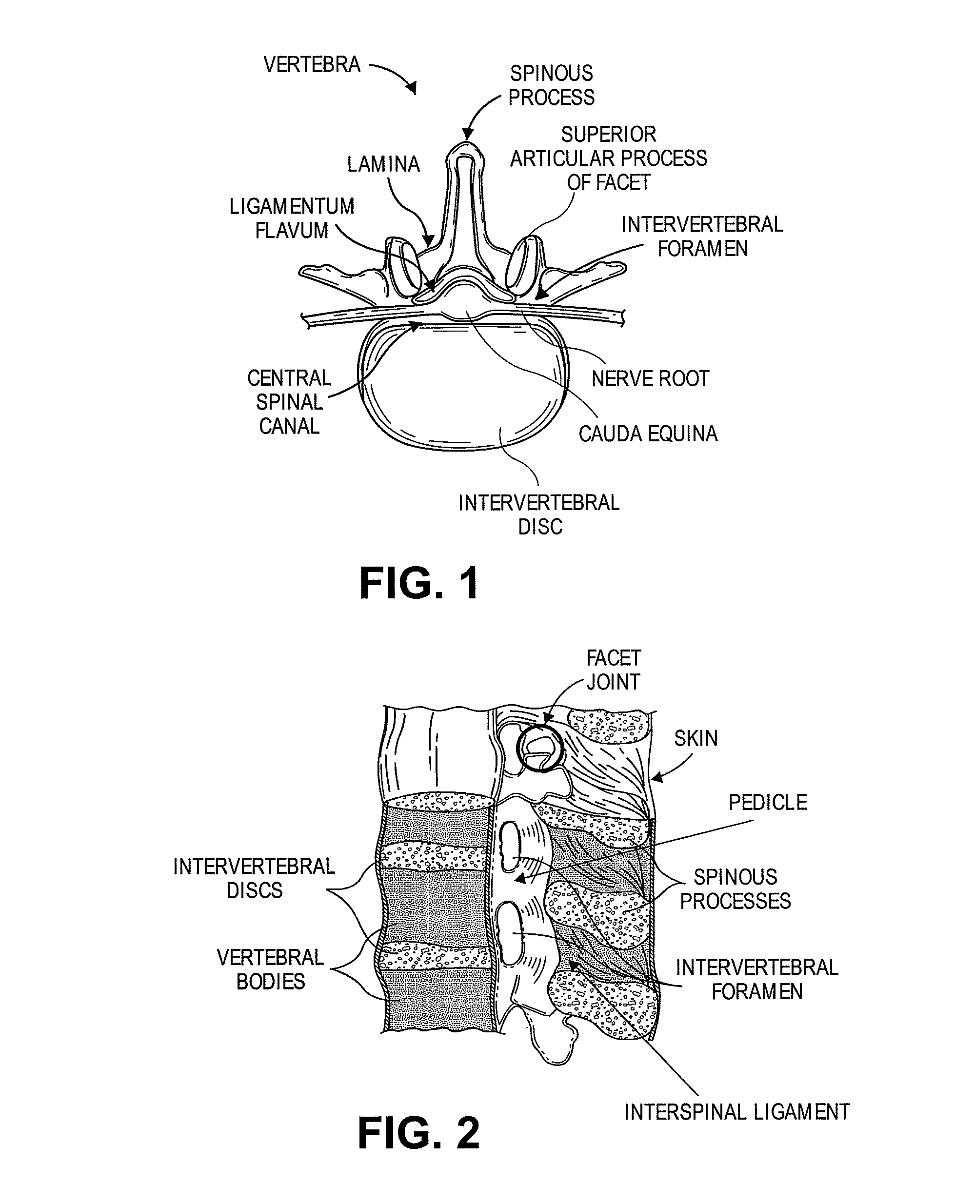 Multiple pathways for spinal nerve root decompression from a single access point