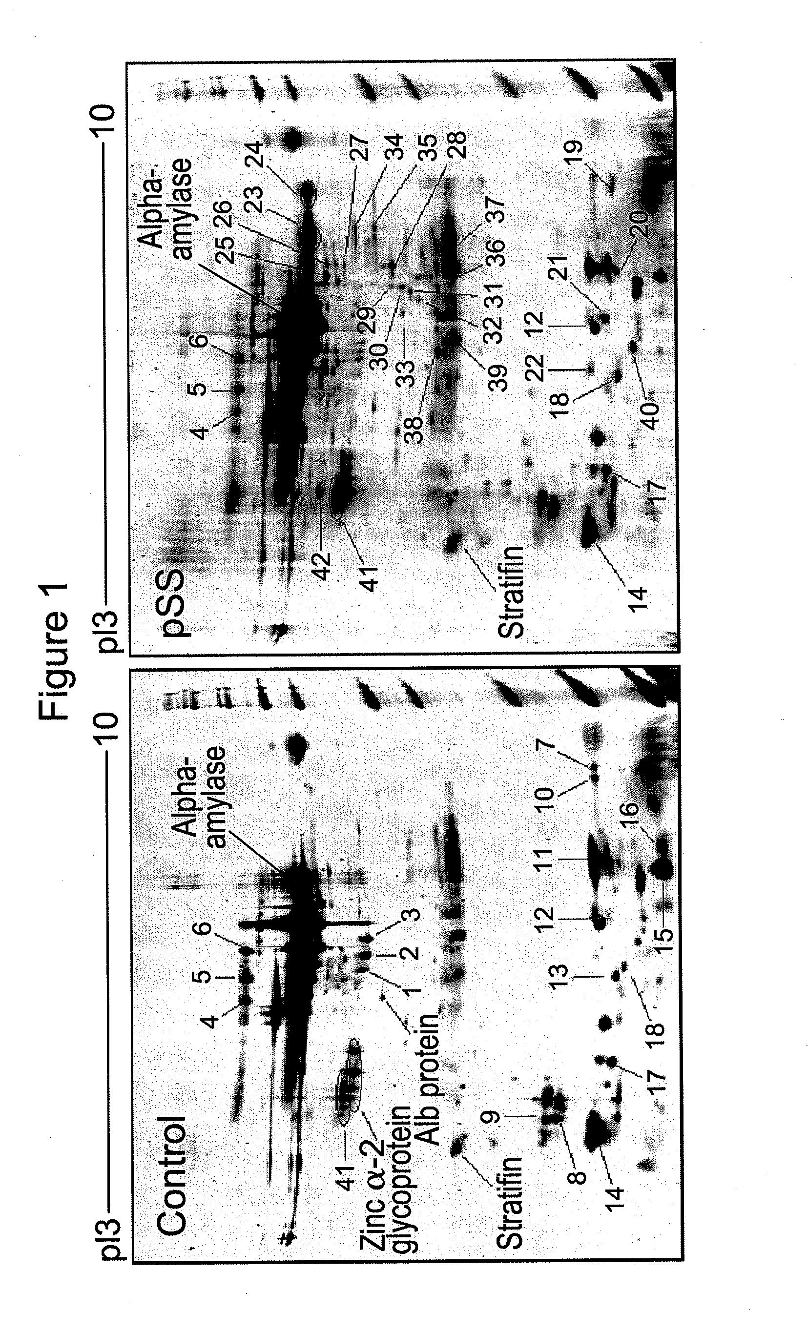 Salivary biomarkers for Sjögren's syndrome