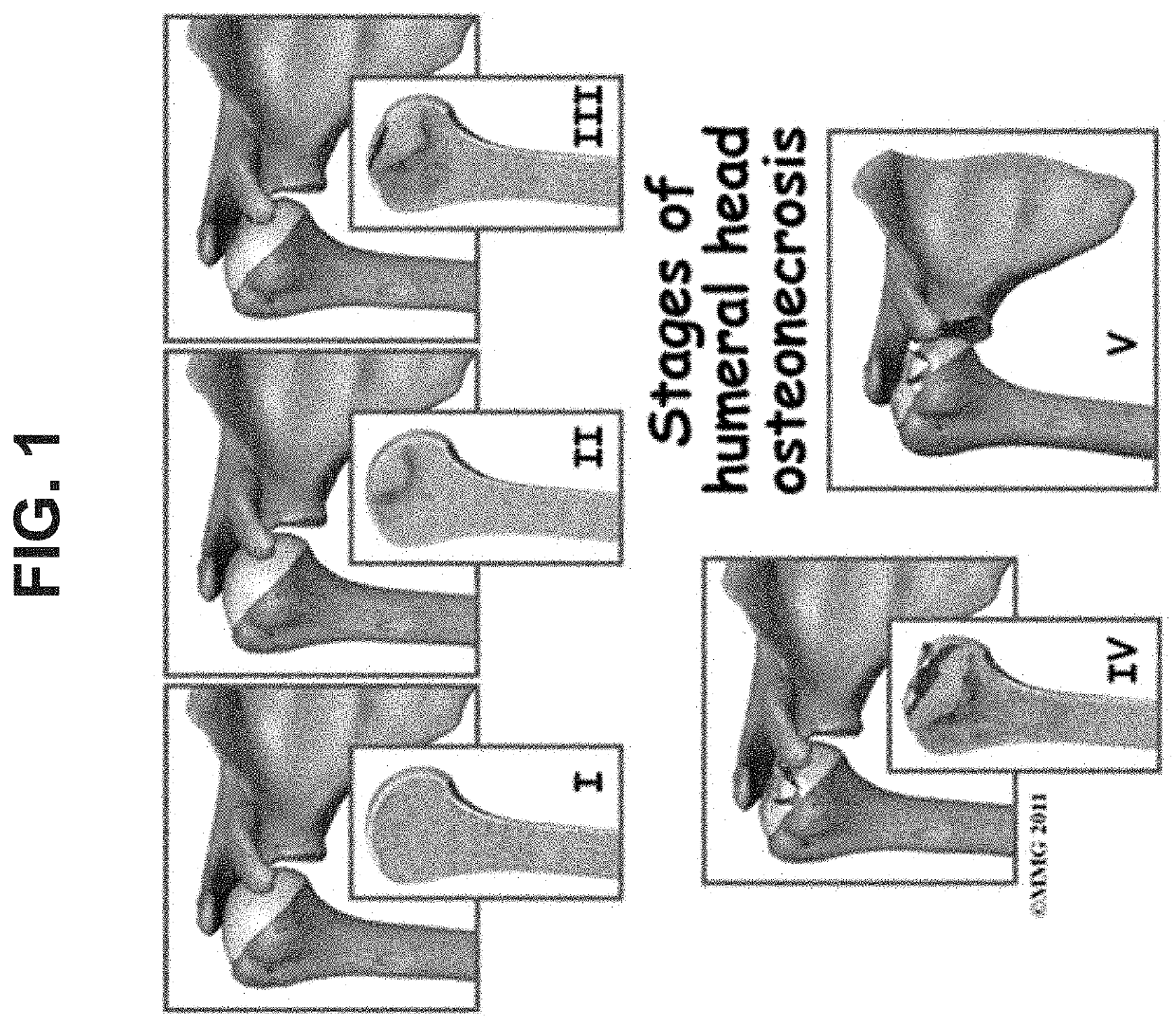 Methods of treating osteonecrosis with llp2a-bisphosphonate compounds