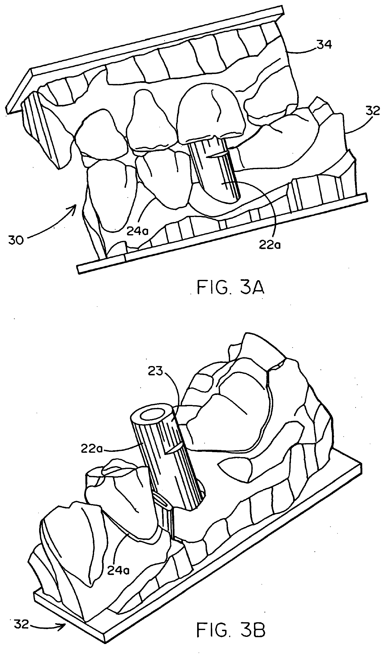 Method of Designing and Fabricating Patient-Specific Restorations from Intra-Oral Scanning of a Digital Impression Coping